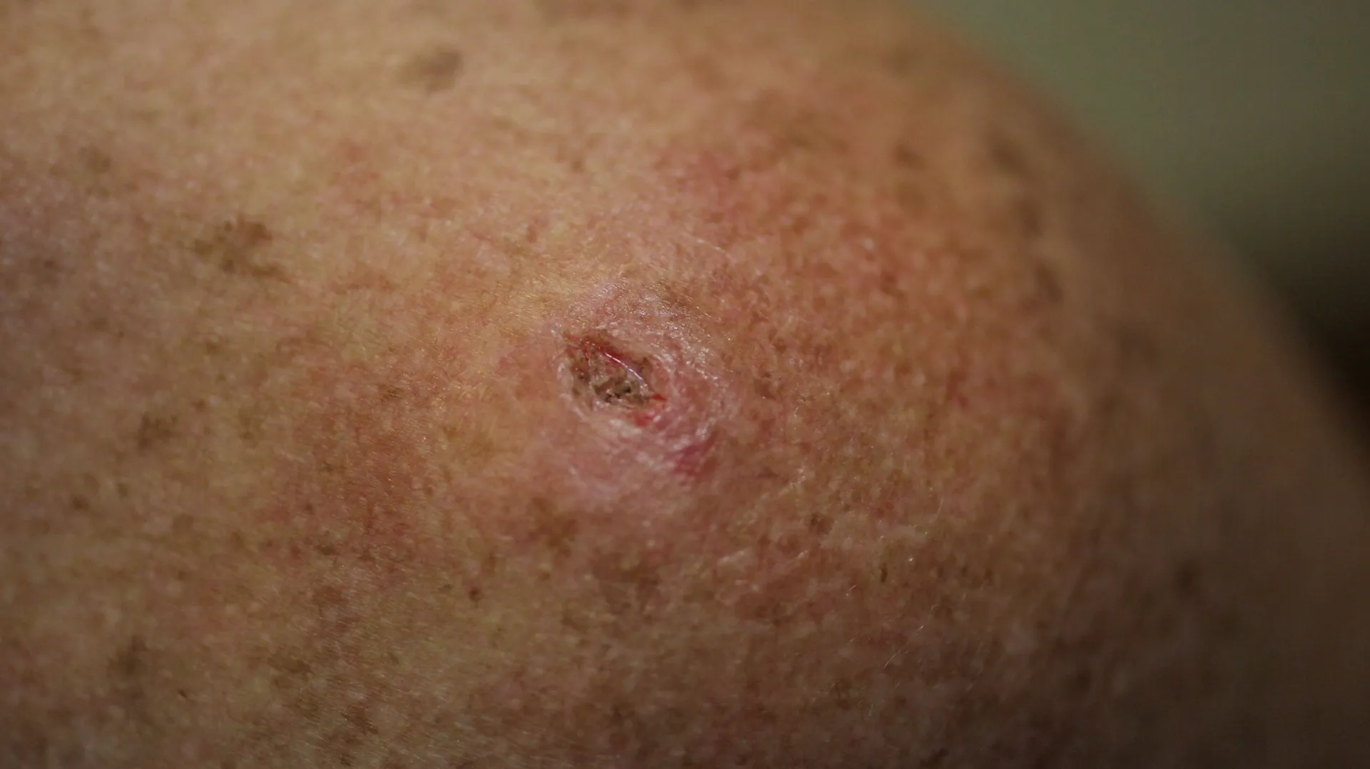 'Une croûte, une plaie qui ne guérit pas, consultez votre dermatologue — free download