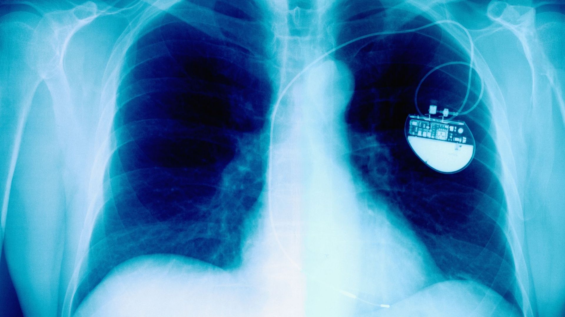 Un premier Belge reçoit un nouveau mini-pacemaker, plus adapté à la ...