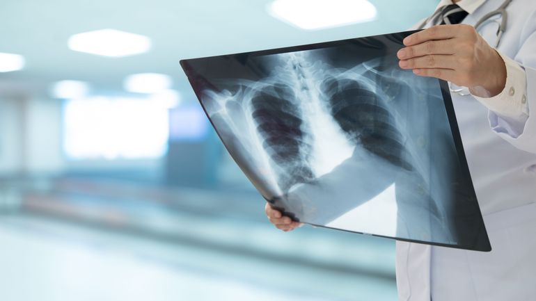 Cancer du poumon : une hausse de près de 20% d'ici 2035 et des femmes de plus en plus touchées