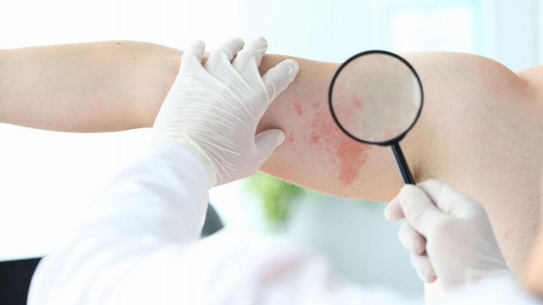 "C'est la gêne", une campagne pour briser le tabou autour du psoriasis génital