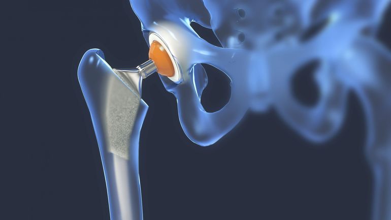 Une prothèse de hanche ou de genou infectée ? Voici une nouvelle arme du futur pour éradiquer l'infection