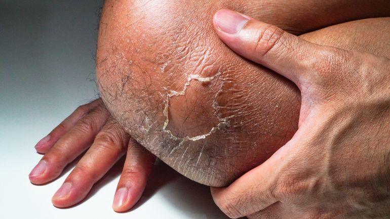 Brûlure au 1er, 2e et 3eme degré : comment les soigner?